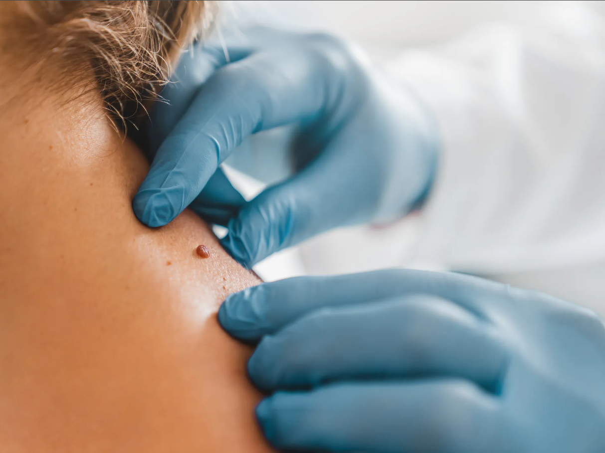 ojas-clinic-skin-tags-removal-treatment-pune-india