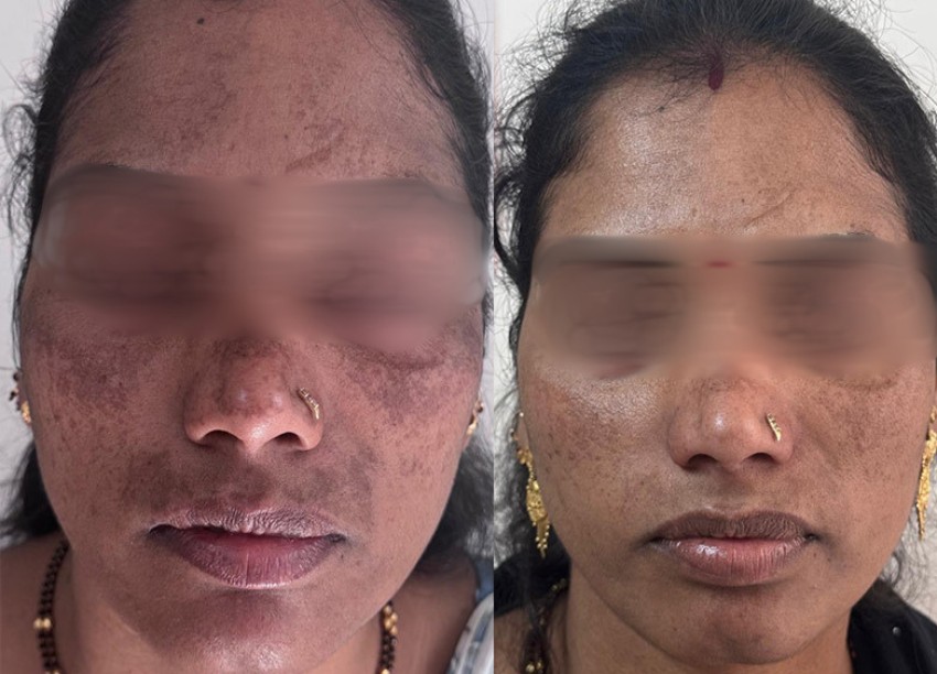Pigmentation consultation