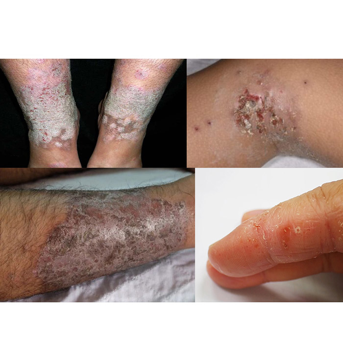 Eczema Treatment