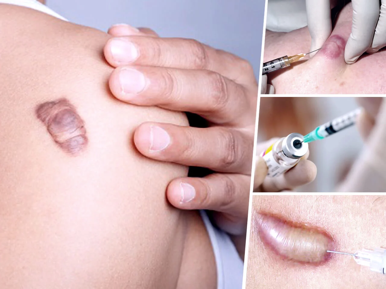 Injections for Keloid Treatment