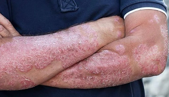 Psoriasis Treatment