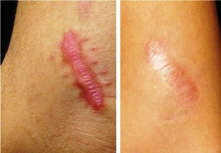 Before After Keloid Treatment