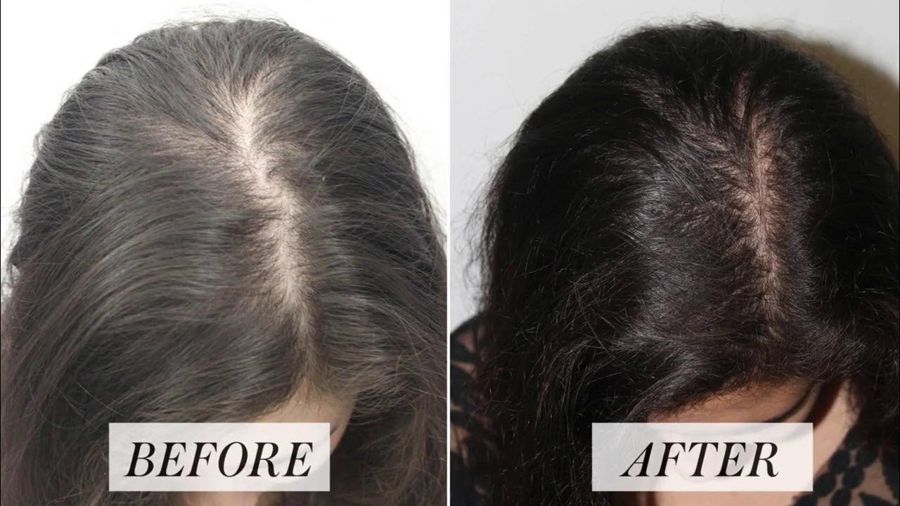 Mesotherapy procedure