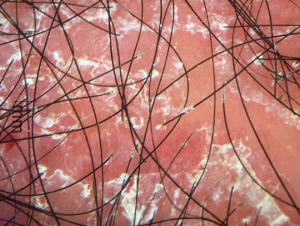 Phototherapy session