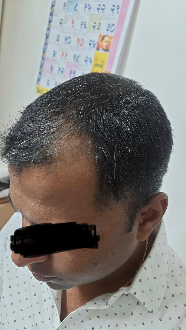 Alopecia therapy