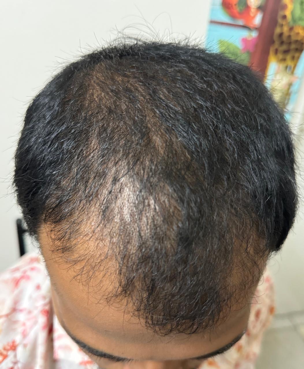 Alopecia therapy
