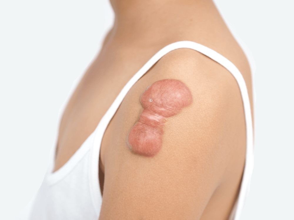 Keloid injection therapy