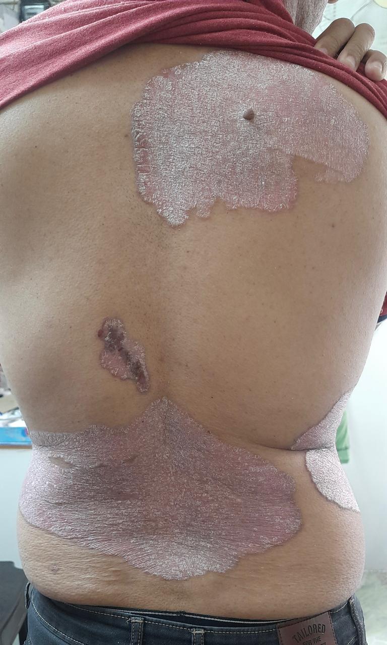 Phototherapy for psoriasis