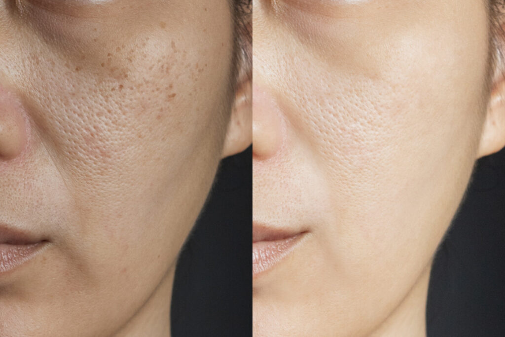Chemical peel procedure
