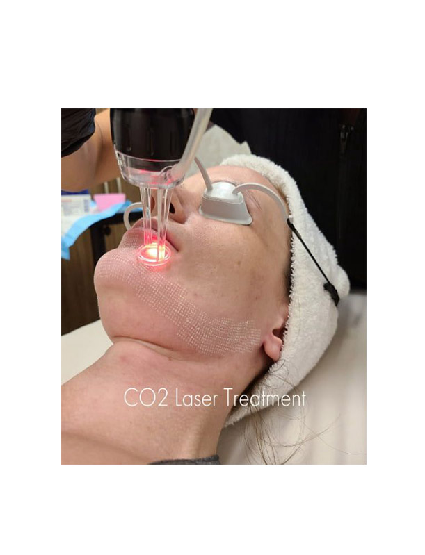 Before CO2 Laser Treatment