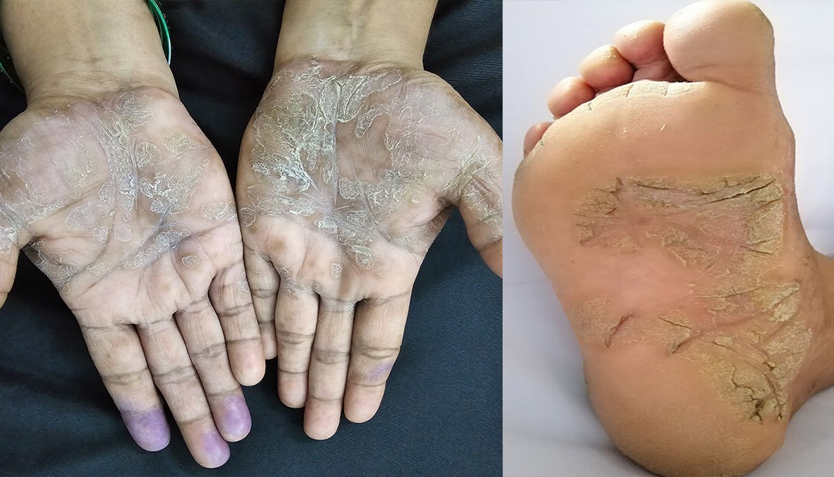 Psoriasis consultation