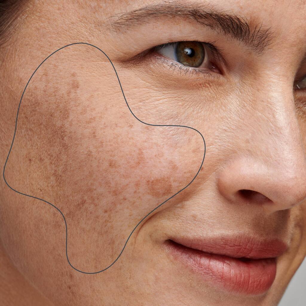 Laser pigmentation treatment