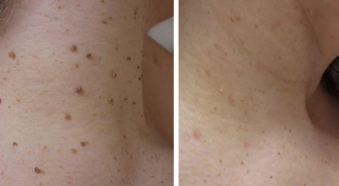 Skin tags removal procedure