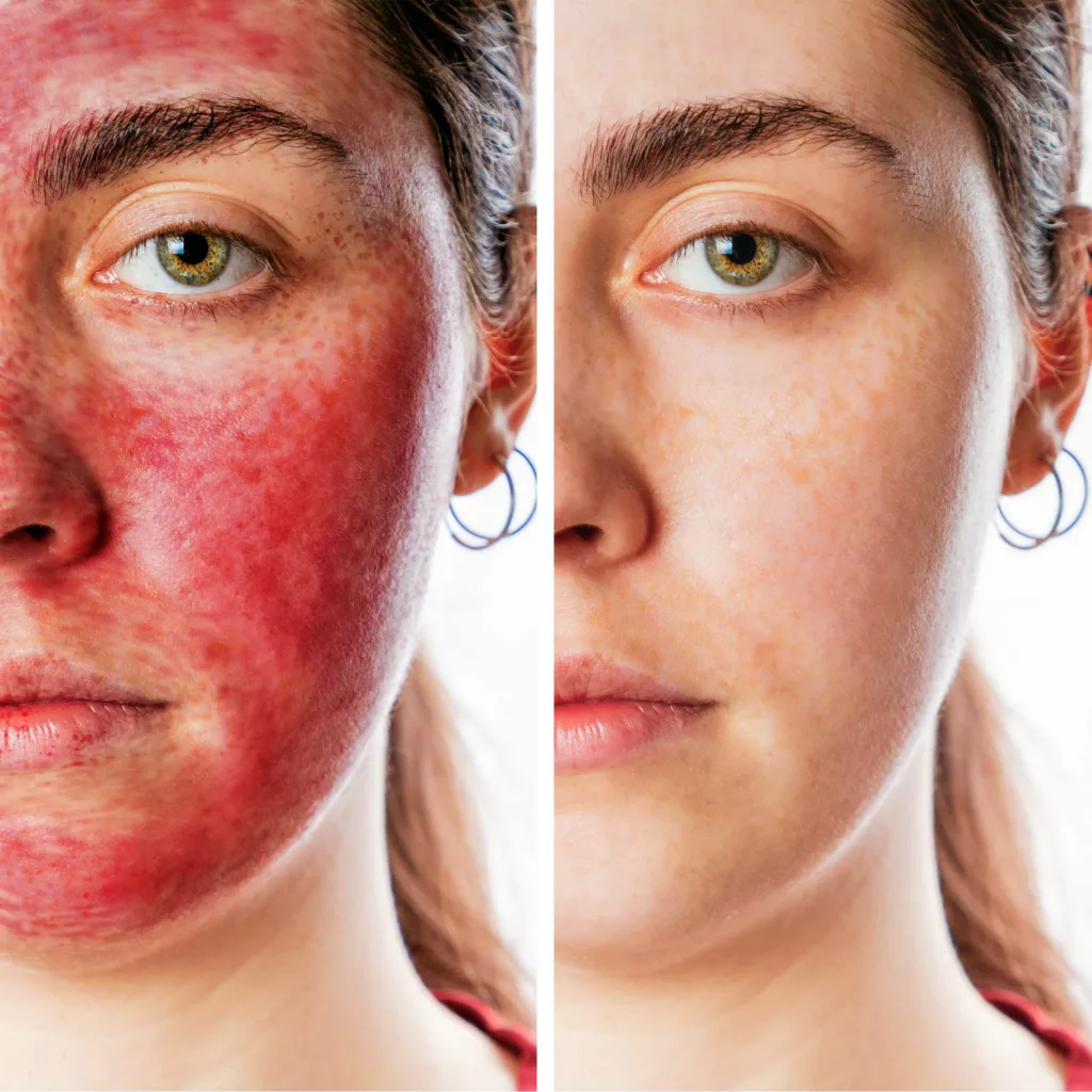 Vampire Facial procedure