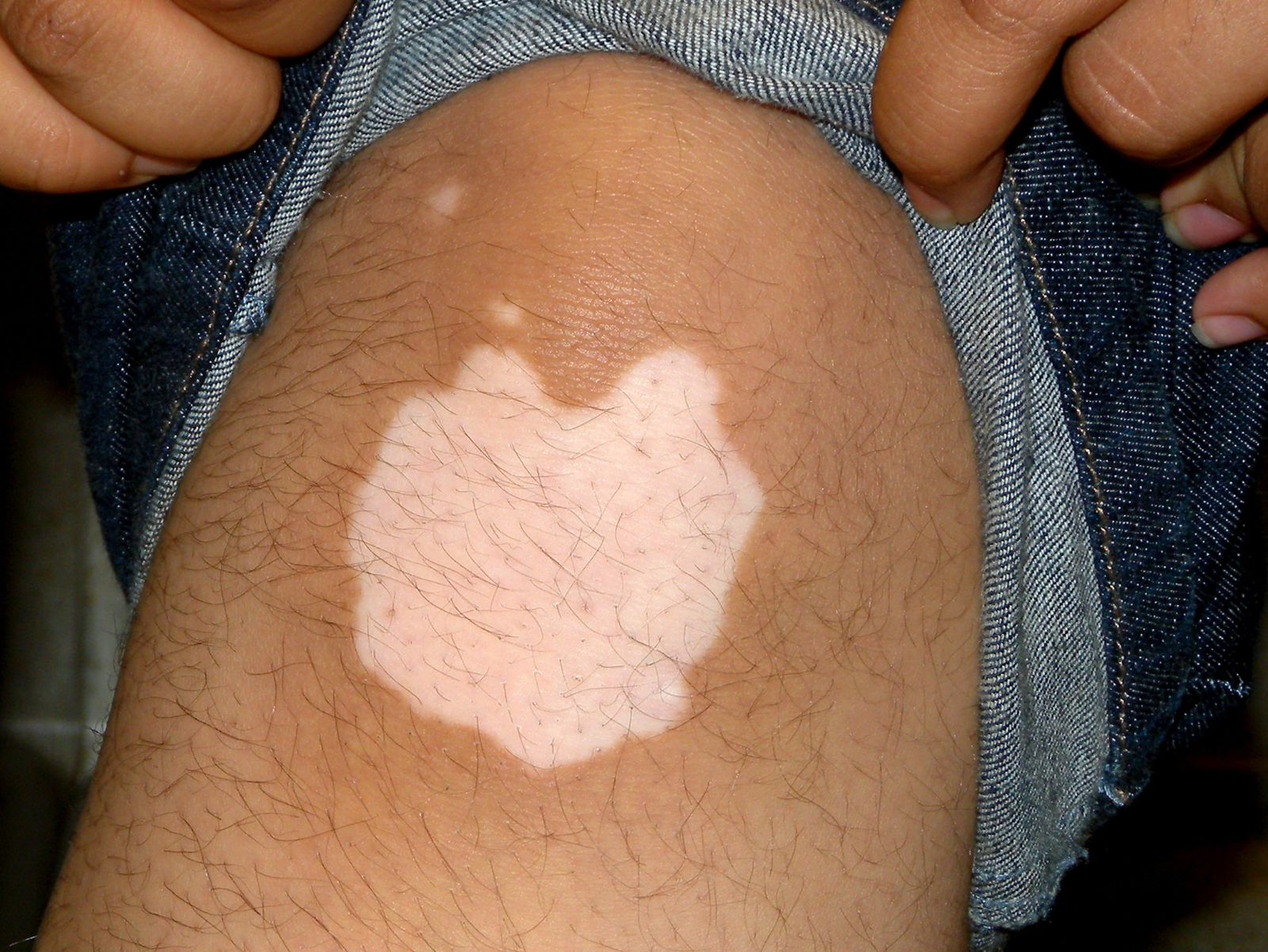 Vitiligo Treatment