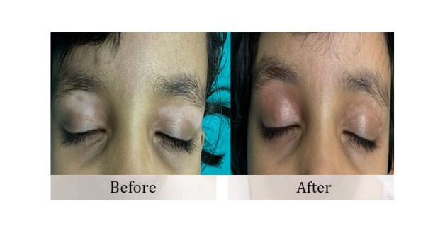 Vitiligo Treatment